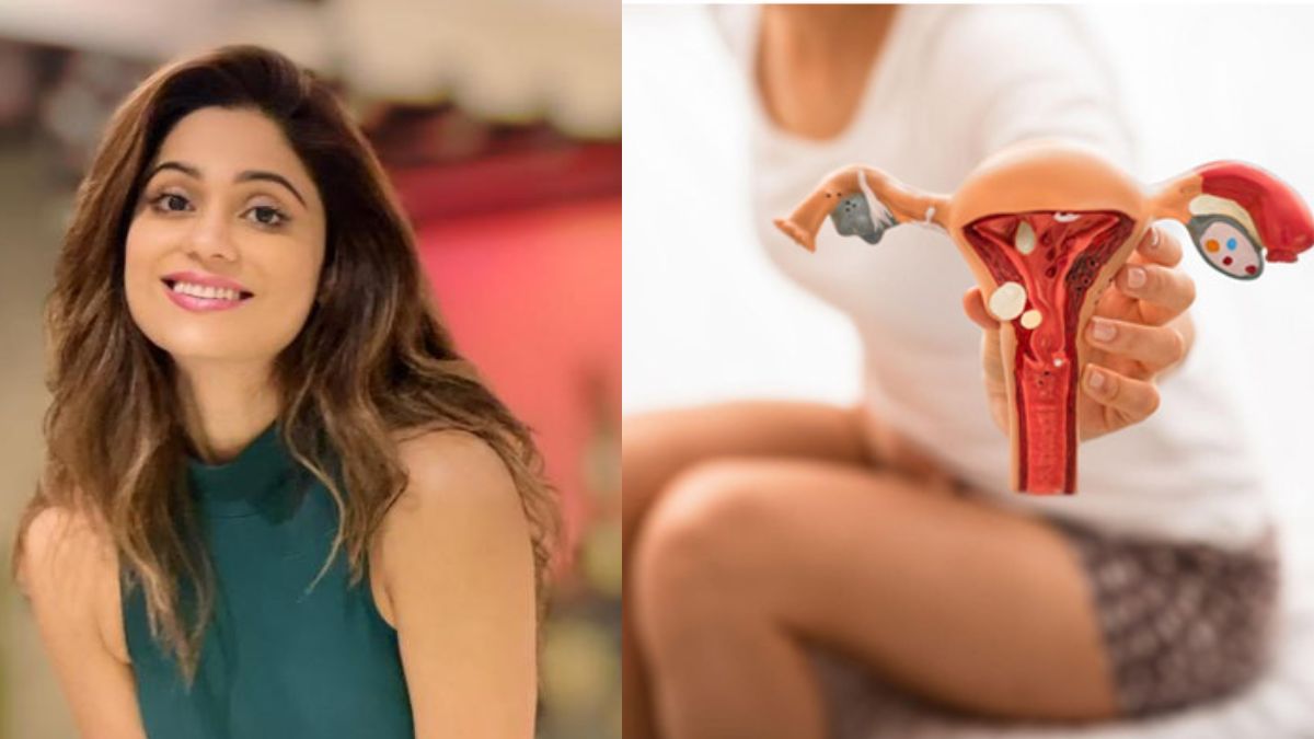 Shamita Shetty Underwent Endometriosis
