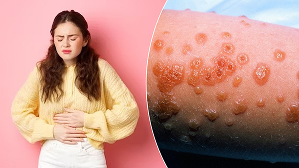 hat Is Stevens Johnson Syndrome Causes And Treatment