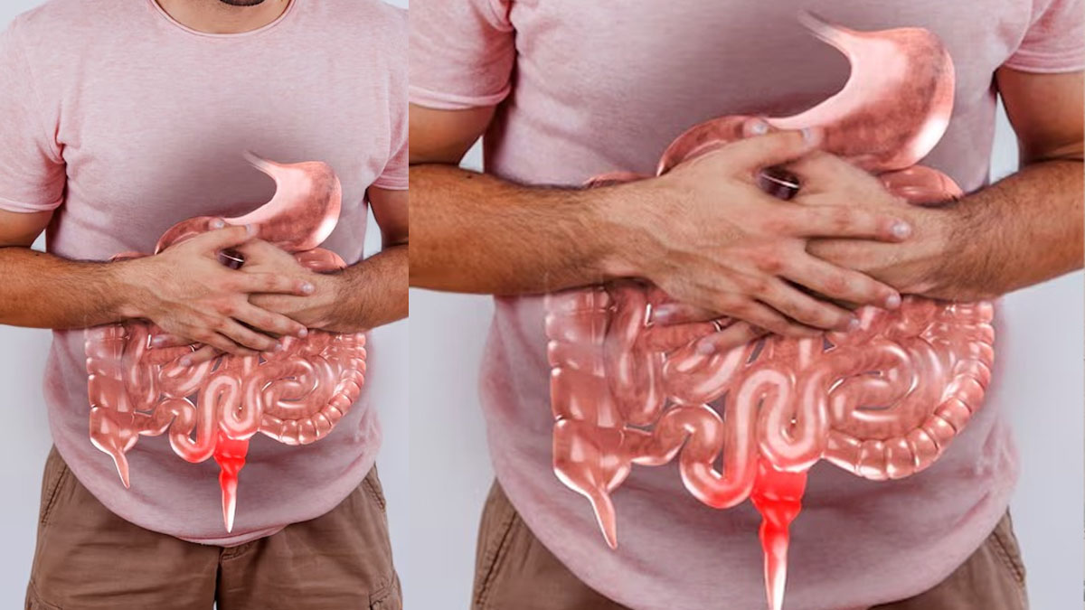 Ulcerative Colitis Stool Symptoms Causes And Prevention Tips In hindi Ulcerative Colitis Stool Symptoms Causes And Prevention Tips In hindi