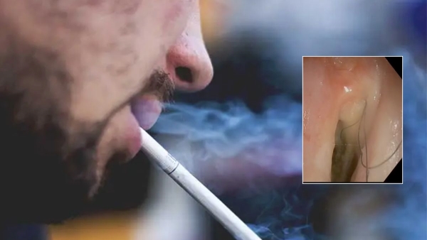 Hairs grow in the THROAT of 52-year-old Austria Man