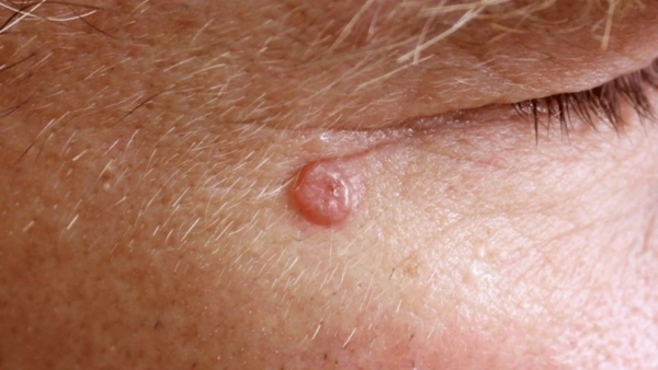 basal cell carcinoma
