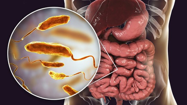 Cholera Cases Rise in Monsoon