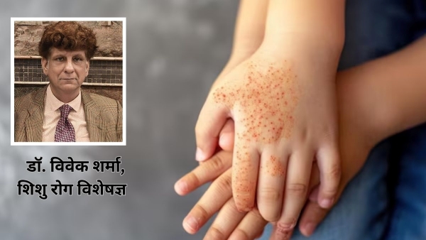 Expert shares tips to prevent From hand foot and mouth disease