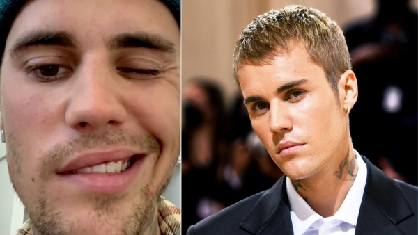 Justin Biber Suffered By Ramsay Hunt syndrome