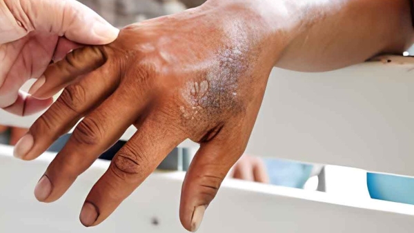 Dimple Kapadia once suffered from leprosy Dimple Kapadia once suffered from leprosy