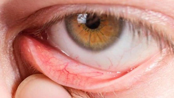 Dry Eye Syndrome Symptoms Everyone Should Know