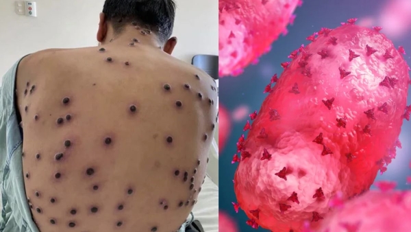 Mpox outbreak AIIMS issues Advisory for Mpox cases in Delhi