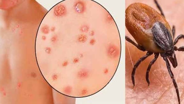 First Scrub Typhus Death Reported in Shimla