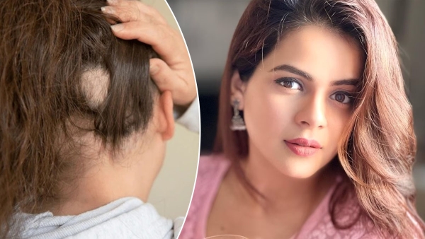 Thapki Pyaar Ki fame Jigyasa Singh is struggling with alopecia baldness disease