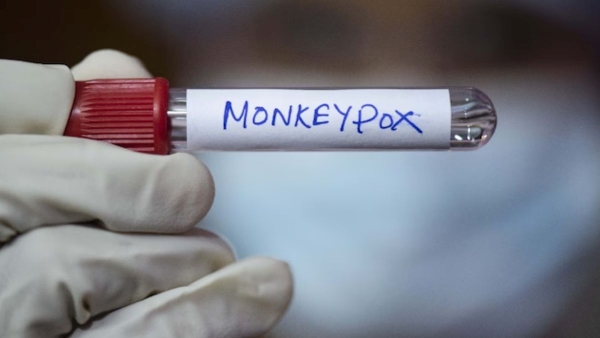 Second Monekypox case confirmed