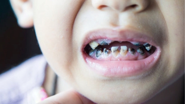 How to stop baby Milk teeth from rotting