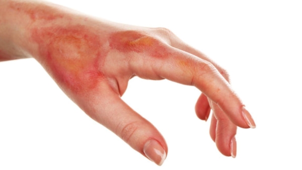 How to treat a minor burn at home