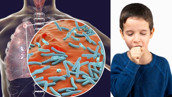 whooping cough symptoms