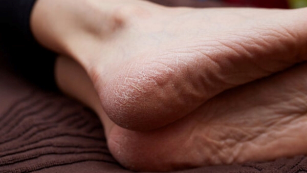 Cracked Heel Remedies Cracked Heel Remedies