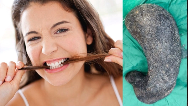 Human hair Found in stomach of woman Human hair Found in stomach of woman