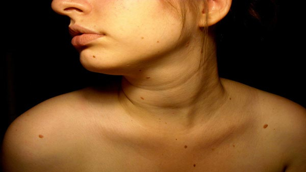 Moles on Neck Good or Bad according to samudrik shastra gale me til ka meaning