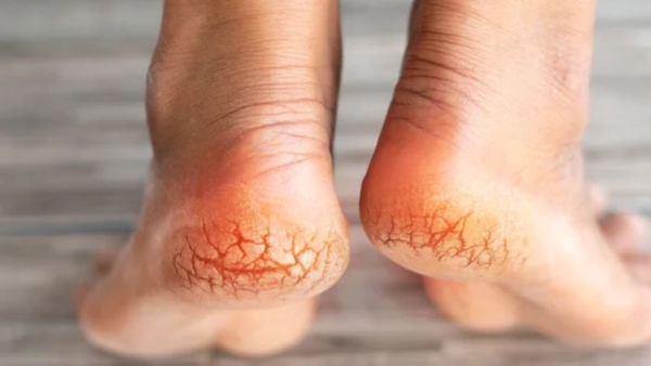 Can vitamins deficiency cause cracked heels