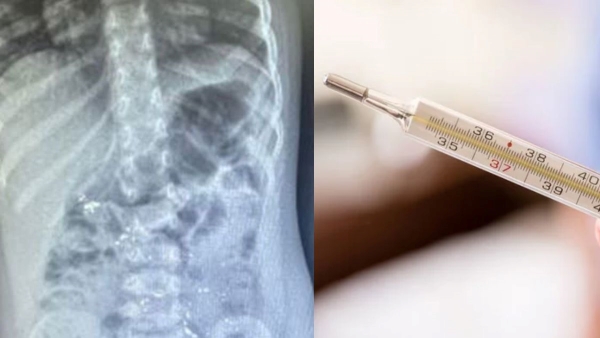 Delhi Doctors Save Toddler From Mercury Poisoning