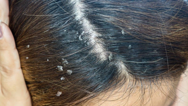 How do you get rid of patchy dandruff How do you get rid of patchy dandruff