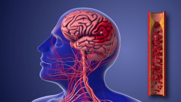 How to Prevent From Brain Stroke