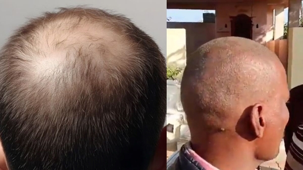 Maharashtra Buldhana People suffer hair loss leading to baldness
