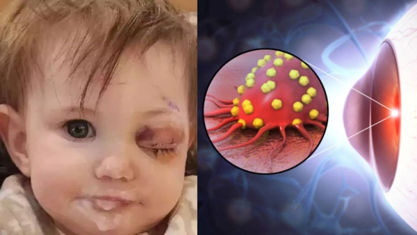 What Is Retinoblastoma