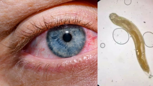 MP Doctors Remove A Live Worm From A Man s Eye