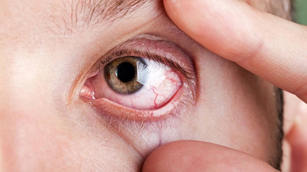 Precautions For Eye Stroke