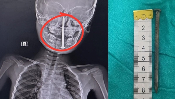 What to Do If Your Child Swallows Any Foreign Object