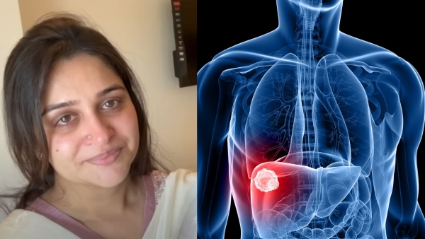dipika kakar diagnosed with liver tumor