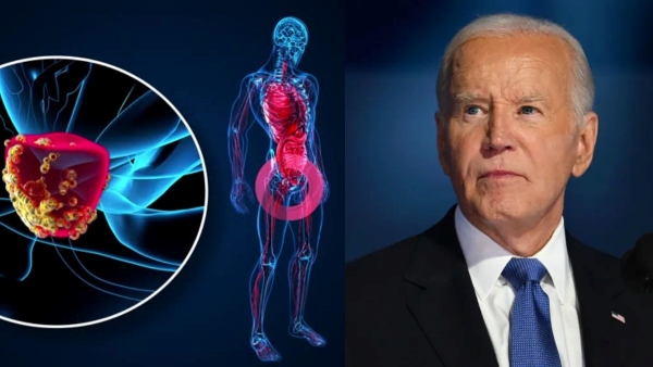 Former US President Biden diagnosed with prostate cancer