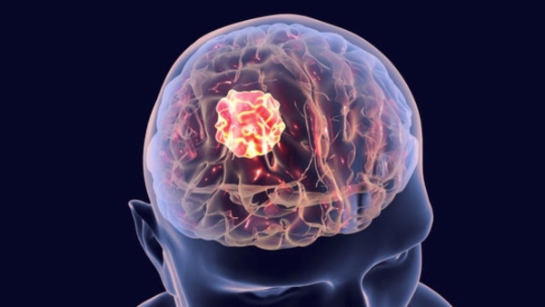 Brain Tumor Warning Sign