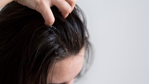 What Vitamin Deficiency the Reason for dandruff