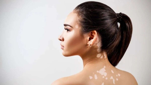 World Vitiligo Day 2025