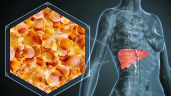 Fatty Liver in India