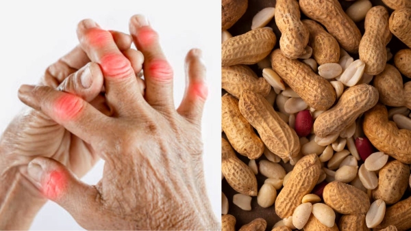 Uric acid and peanuts - - - 3 20-30 - - - - - - -
