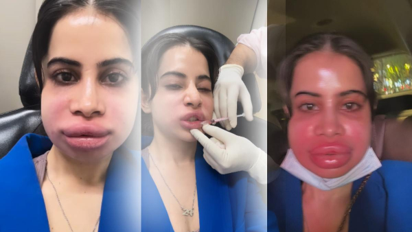 Urfi Javed Lips Fillers Urfi Javed Lips Fillers