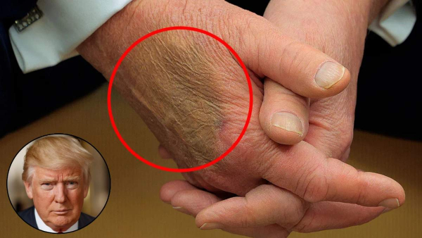 Donald Trump Health Update