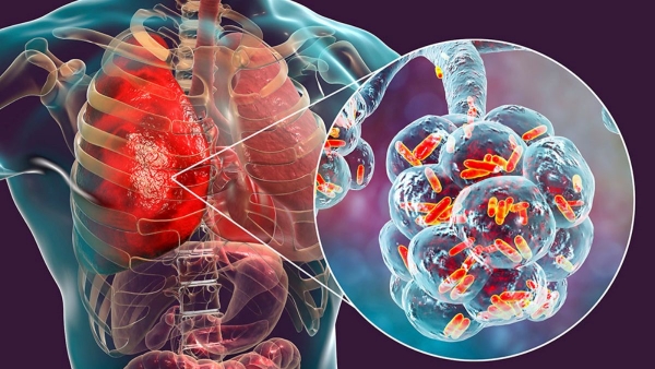 Legionnaires Disease Outbreak in New York Legionnaires Disease Outbreak in New York