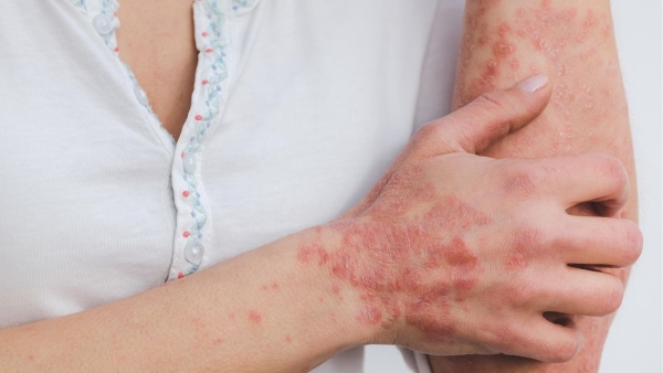 foods to avoid in psoriasis