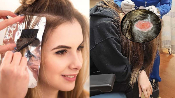 Hair dye side effects