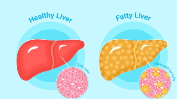 Alcoholic Vs Non-Alcoholic Fatty Liver