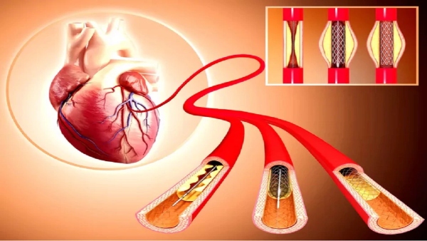 Angioplasty Benefits