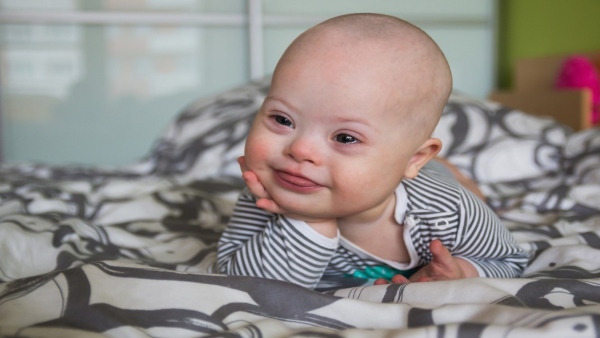 Down Syndrome Down Syndrome