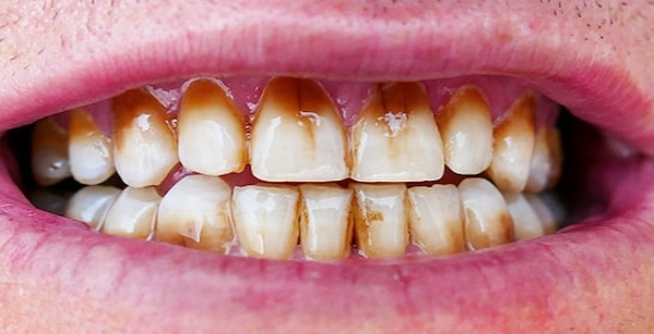 Yellow Teeth Remedies