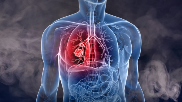 Lung Cancer Causes