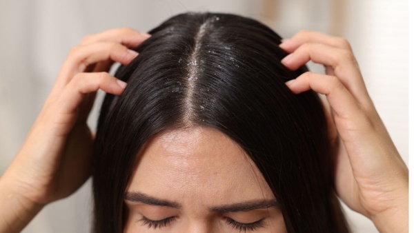 Dandruff Home Remedies