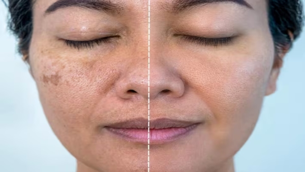 Pigmentation Home Remedies