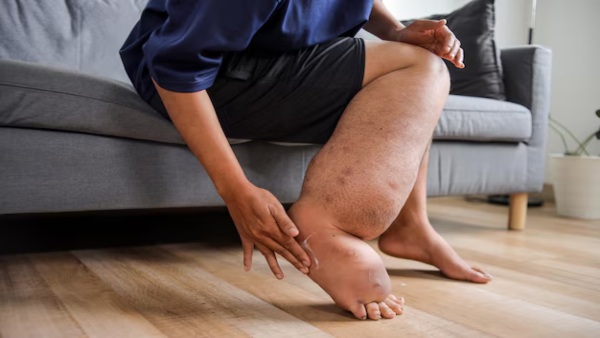 Lymphatic Filariasis