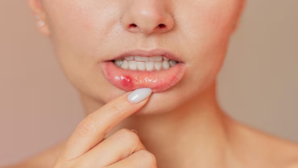 Mouth Ulcers Home Remedies Mouth Ulcers Home Remedies
